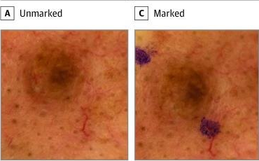 Published dermoscopy examples with and without surgical ink markings, from Winkler and colleagues, 2019. Ink is a collection artefact, not a crafted attack.